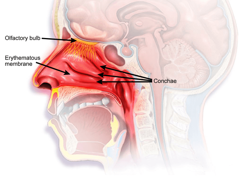 Rhinitis medicamentosa - Wikipedia