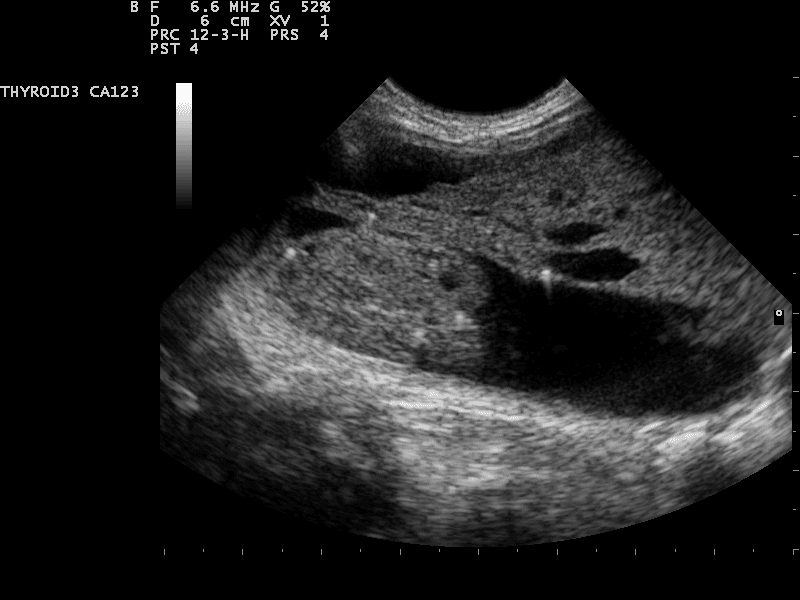 Thyroid nodule - Wikipedia