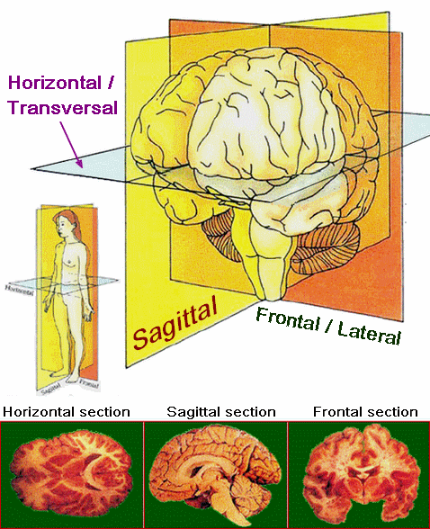 Paralysie supranucléaire progressive — Wikipédia