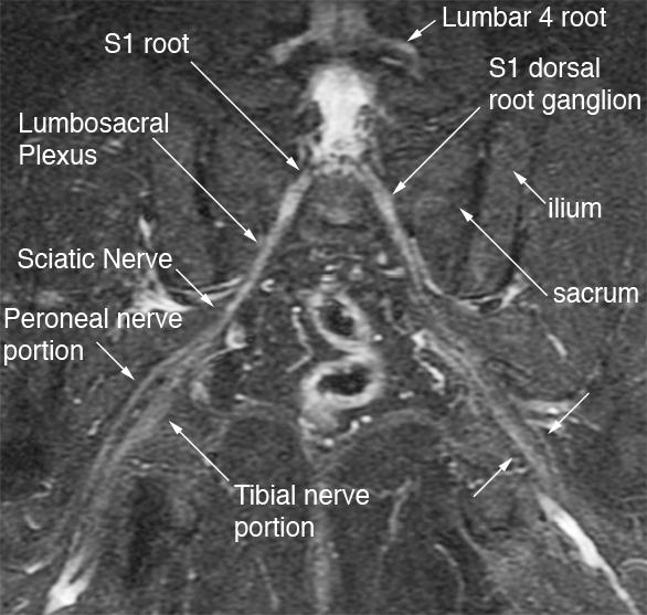 Magnetic resonance neurography - Wikipedia