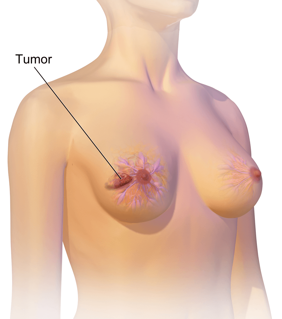 Breast cancer - Wikipedia