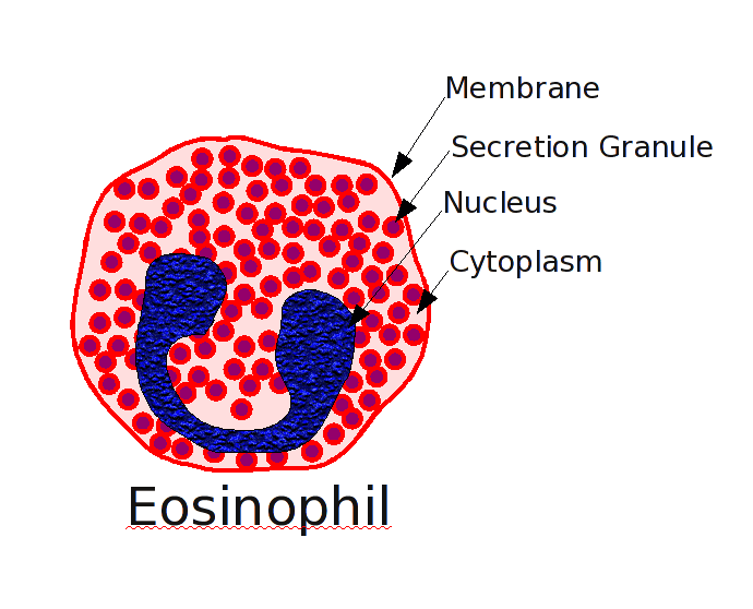Eosinophilic pneumonia - Wikipedia