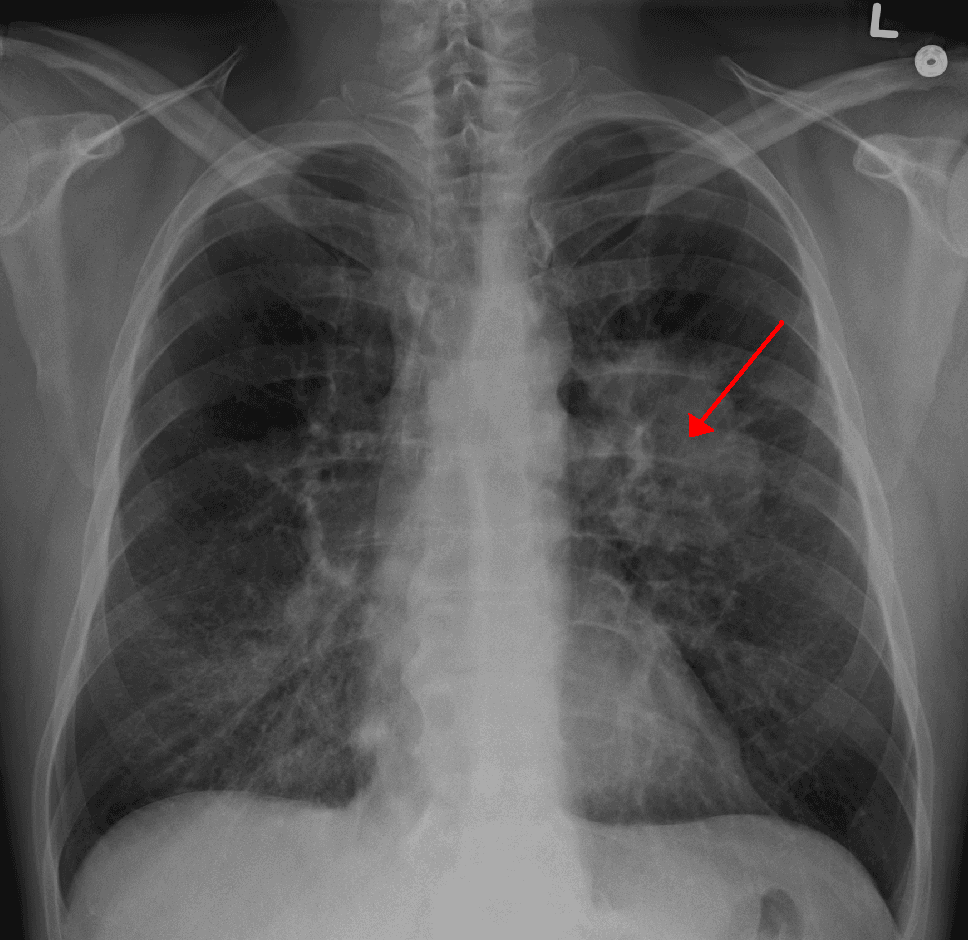 Lung cancer - Wikipedia