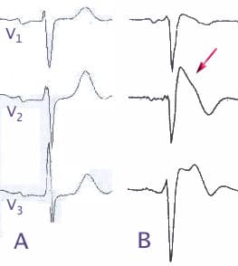 Syndrome de Brugada — Wikipédia