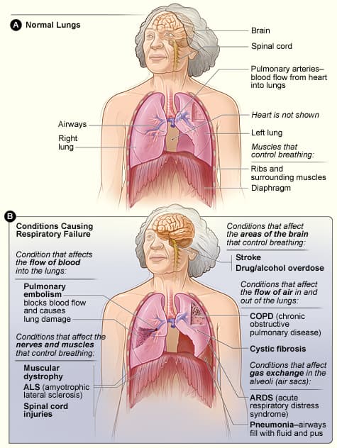 Respiratory failure - Wikipedia