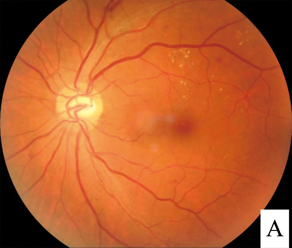 Diabetic retinopathy - Wikipedia