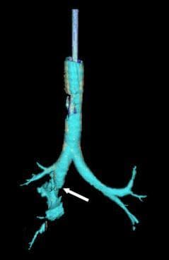 Tracheobronchial injury - Wikipedia