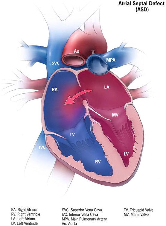 Atrial septal defect - Wikipedia