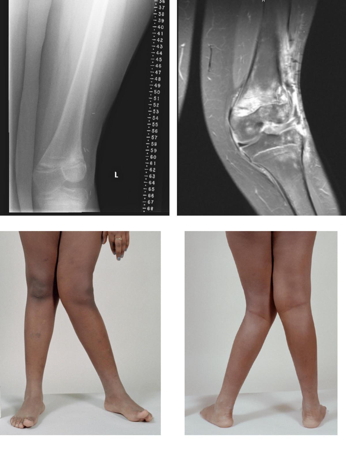 Valgus deformity - Wikipedia