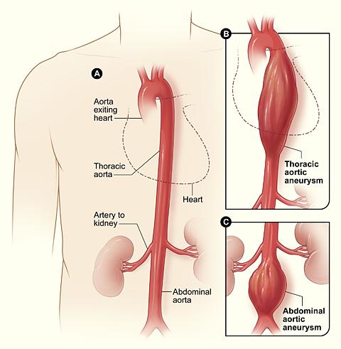 Anévrisme de l'aorte abdominale — Wikipédia