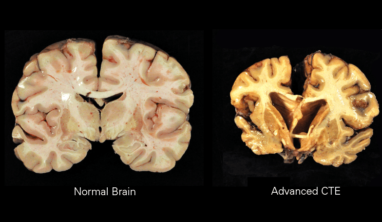 Encéphalopathie traumatique chronique — Wikipédia