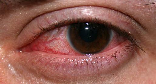 Keratitis - Wikipedia