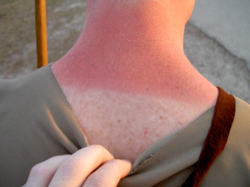 Sunburn - Wikipedia