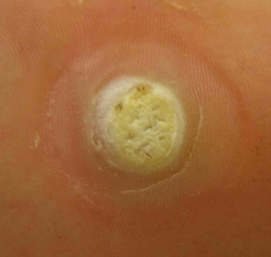 Plantar wart - Wikipedia