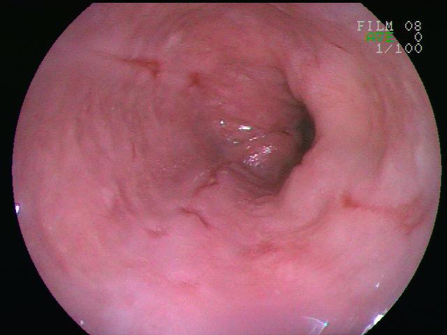 Esophagitis - Wikipedia