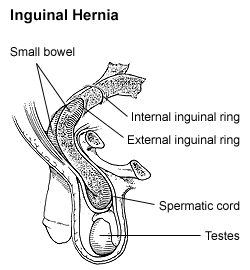 Inguinal hernia - Wikipedia