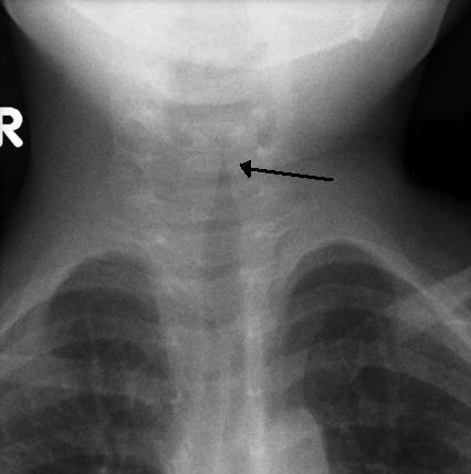 Croup - Wikipedia