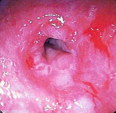 Esophageal stricture - Wikipedia