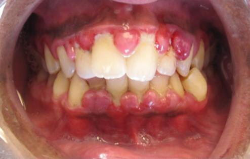 Gingivitis - Wikipedia