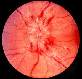 Papilledema - Wikipedia