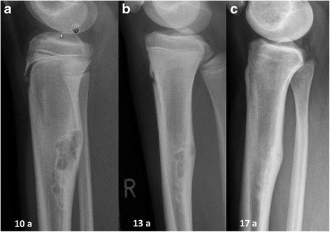 Bone tumor - Wikipedia