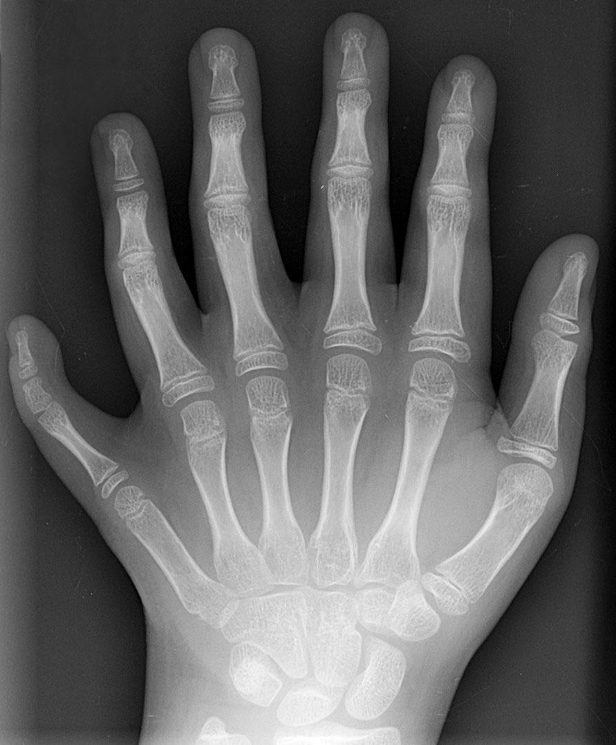 Polydactylie — Wikipédia