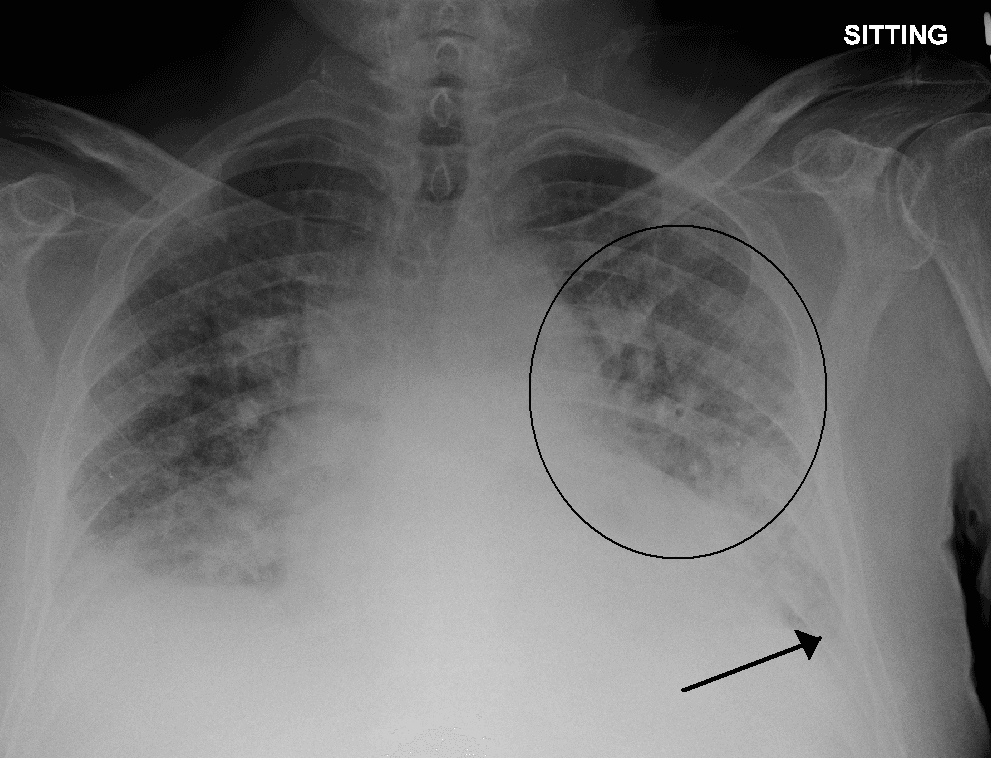 Pulmonary edema - Wikipedia