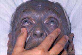 Argyria - Wikipedia