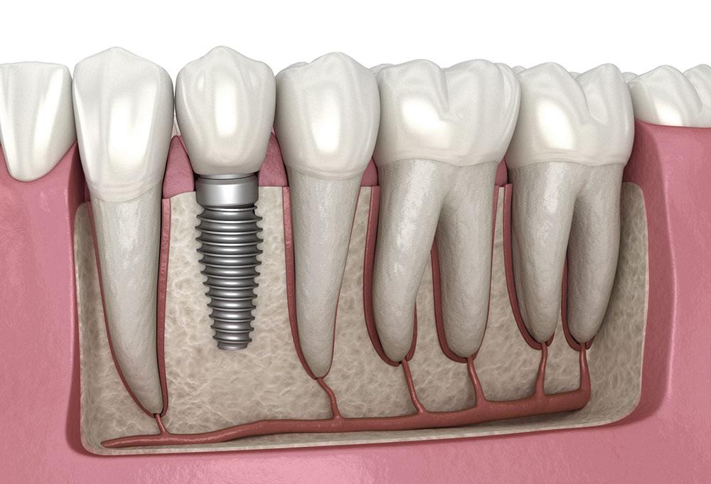 Dental implant - Wikipedia