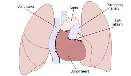 Heart transplantation - Wikipedia