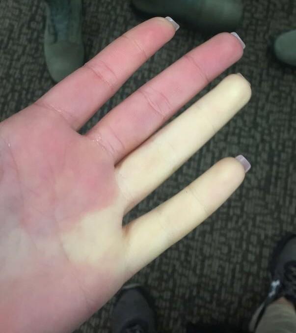 Raynaud syndrome - Wikipedia