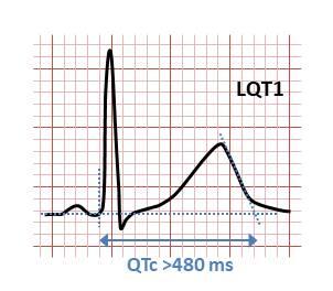 Long QT syndrome - Wikipedia