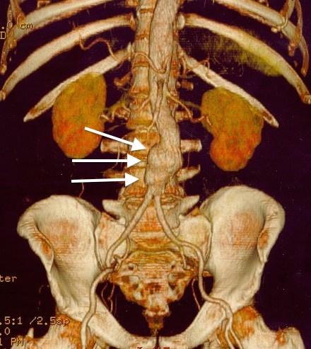 Abdominal aortic aneurysm - Wikipedia