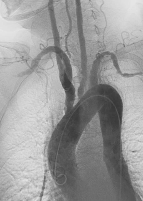 Takayasu's arteritis - Wikipedia