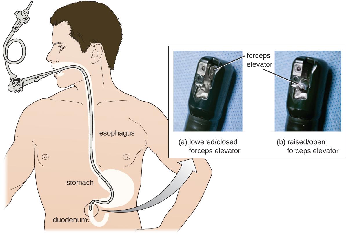 Endoscopie digestive haute — Wikipédia