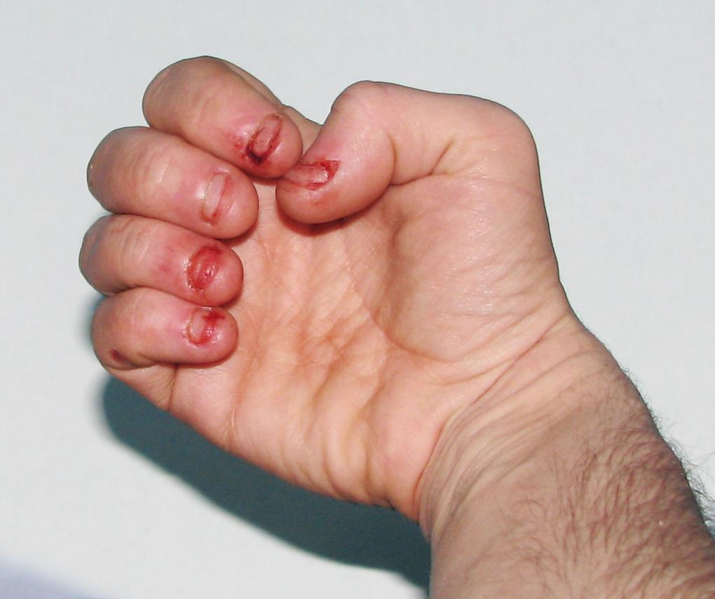 Dermatophagia - Wikipedia