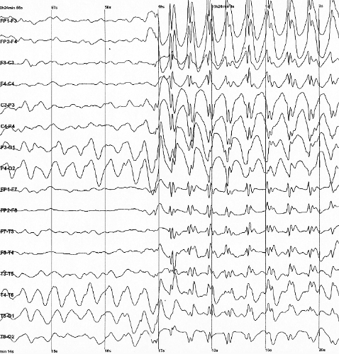 Spike-and-wave - Wikipedia