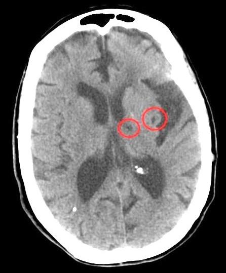 Lacunar stroke - Wikipedia