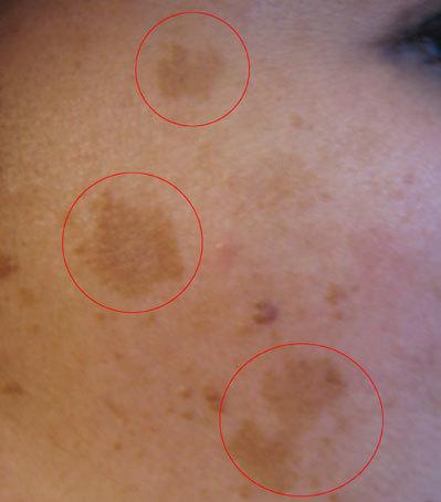 Melasma - Wikipedia