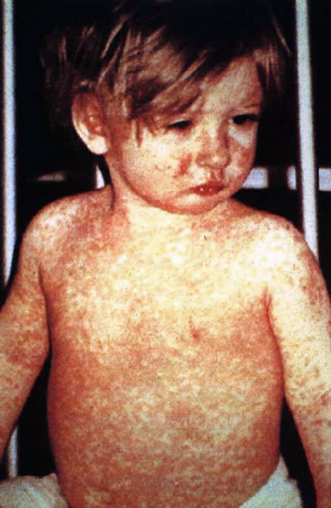 Measles - Wikipedia