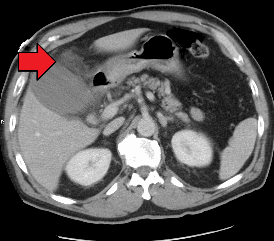 Cholecystitis - Wikipedia