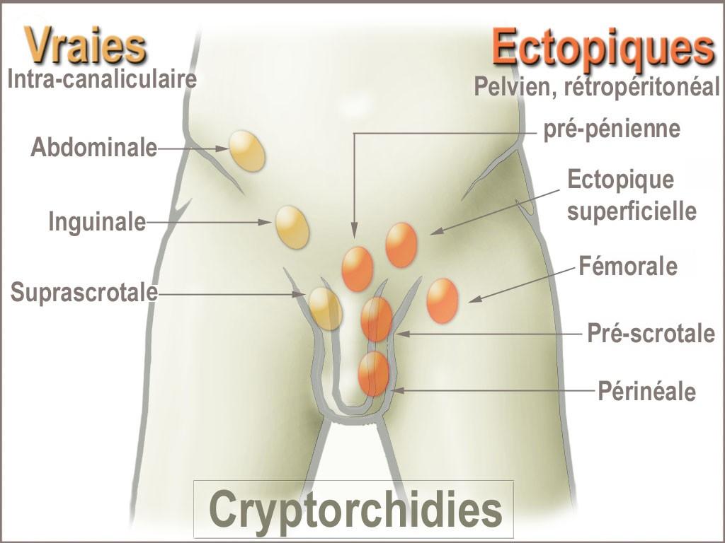 Cryptorchidie — Wikipédia