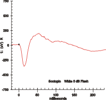 Électrorétinographie — Wikipédia