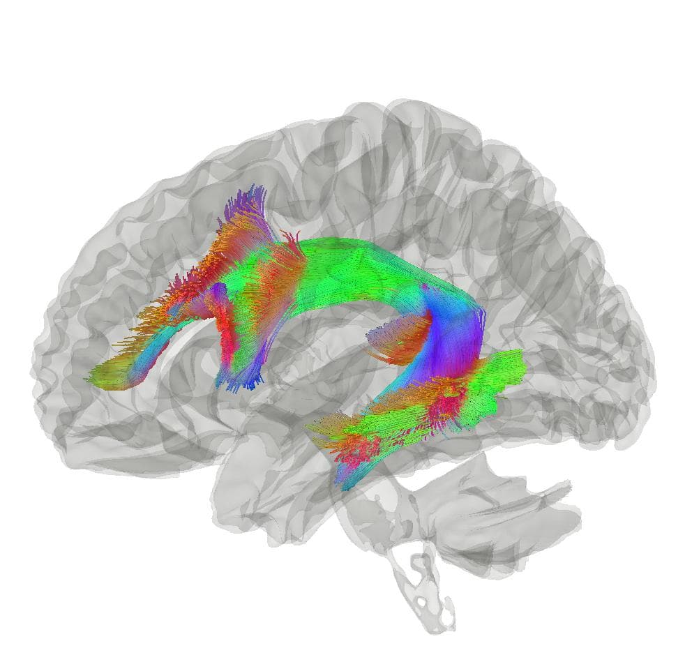 Arcuate fasciculus - Wikipedia