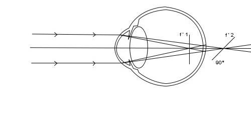 Astigmatisme (médecine) — Wikipédia