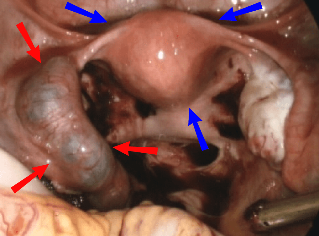 Ectopic pregnancy - Wikipedia