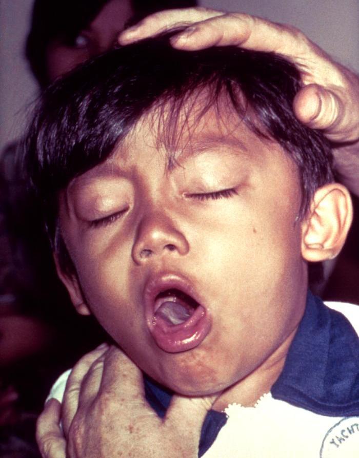 Whooping cough - Wikipedia