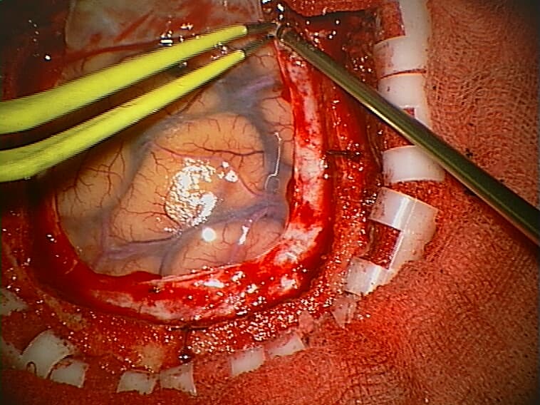 Craniotomy - Wikipedia