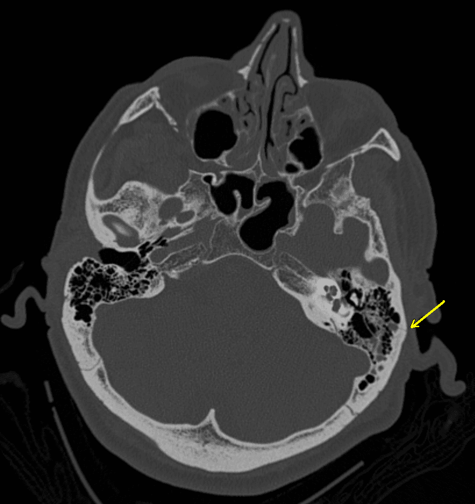 Basilar skull fracture - Wikipedia