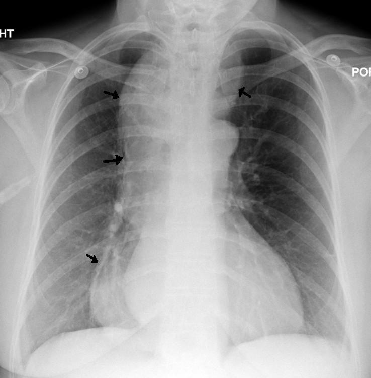 Esophageal achalasia - Wikipedia